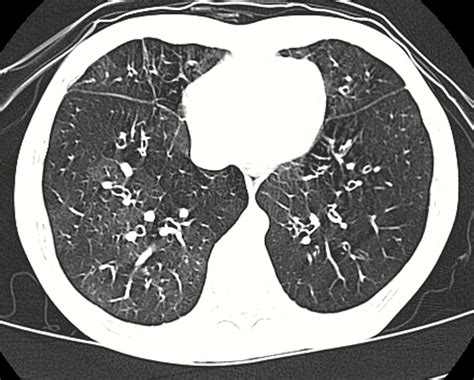 Bronchiolitis obliterans - Wikipedia