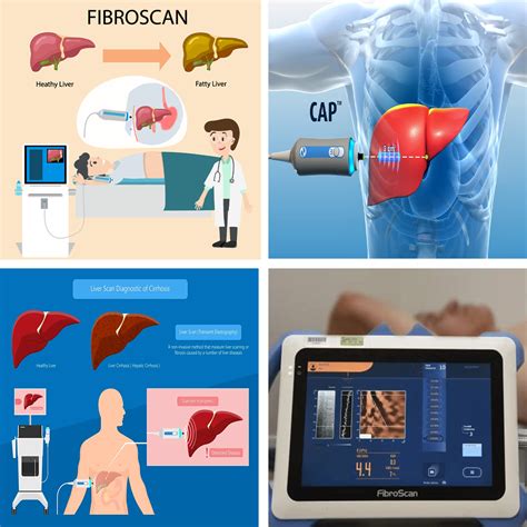 FibroScan - ayushmancinics