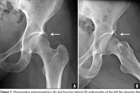 [PDF] Acute severe hip pain associated with labral calcific deposition ...