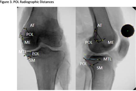 Poster 127: The Posteromedial Knee: An Anatomic, Biomechanical, and Radiographic Analysis of the ...