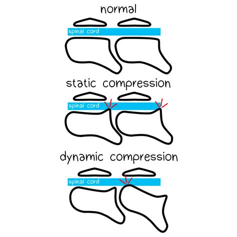 Wobblers Syndrome - Pathology and Ponies