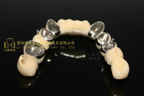 Dental Telescope Denture, Telesope Crown, Dental Prothesis, Laboratoire Dentaire, Dentallabor ...