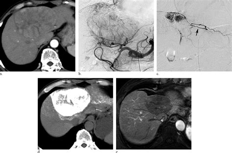 Superselective Conventional Transarterial Chemoembolization for Hepatocellular Carcinoma ...