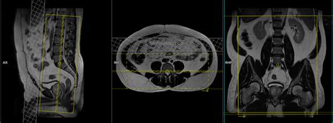 Lumbosacral Plexus MRI Protocols and Planning | Indications for MRI lumbosacral plexus scan