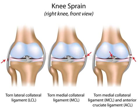 Knee sprain stock vector. Illustration of meniscus, bone - 28259714