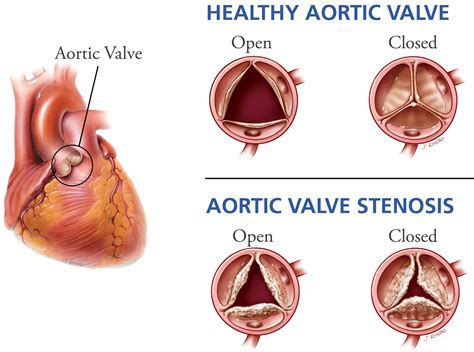 Aortic Valve Disease - Causes, Symptoms, Exercises And Treatment