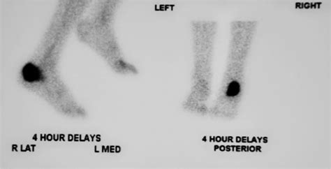 Osteomyelitis causes, risk factors, signs, symptoms, diagnosis & treatment