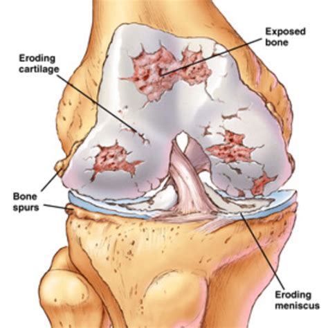 Arthritis | 🏥Singapore Orthopaedic & Sports Medicine