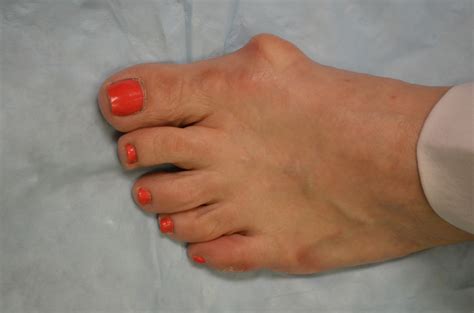 Big Toe Injuries: Bunions