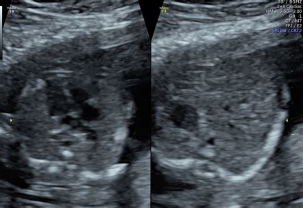 Transposition of the great arteries (TGA) - fetal echocardiogram | Radiology Case | Radiopaedia.org