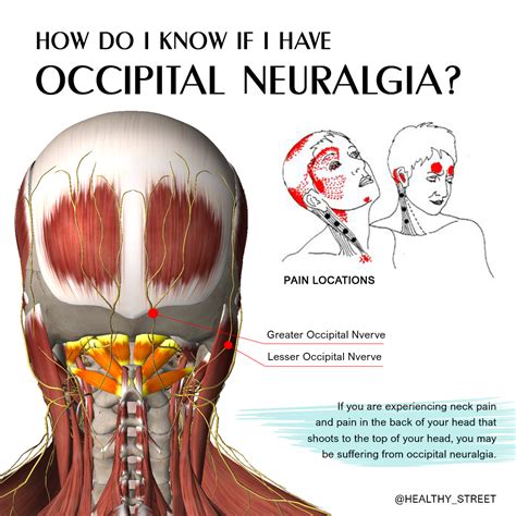 Occipital Neuralgia Cures