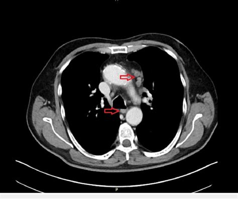 Ct Scan Neck Lymph Nodes