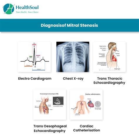 Mitral Valve Stenosis: Symptoms and Treatment | Cardiology | HealthSoul