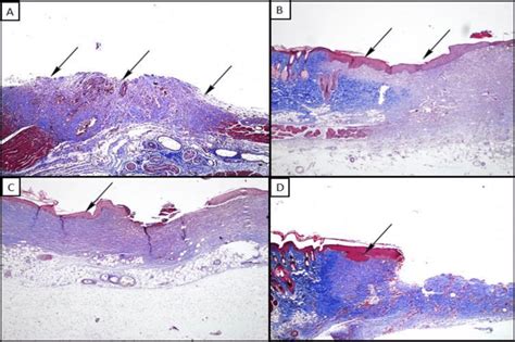 A: Complete removal of epidermis and irregular granulation tissue ...