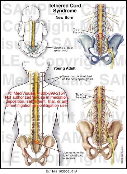 Medivisuals Tethered Cord Syndrome Medical Illustration