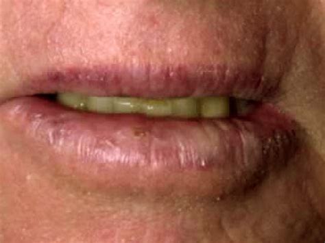 👉 Actinic Cheilitis - Pictures, Treatment, Symptoms, Causes (December 2021)