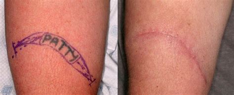 Rimozione Tatuaggio Escissione chirurgica Tattoo removal Surgical ...