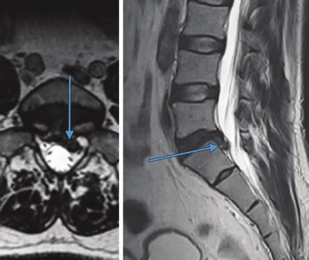 Paracentral Disc Herniation