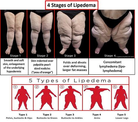 Home | Oregon Lipedema/Dercum Disease Support Group