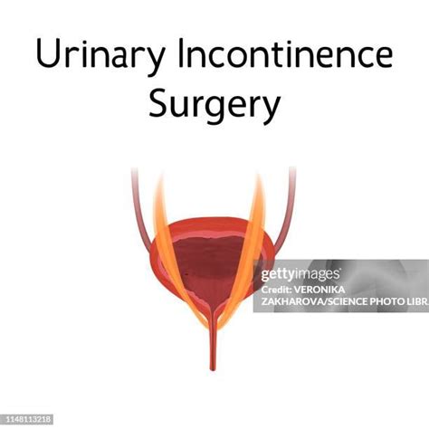 Stress Urinary Incontinence Photos and Premium High Res Pictures ...