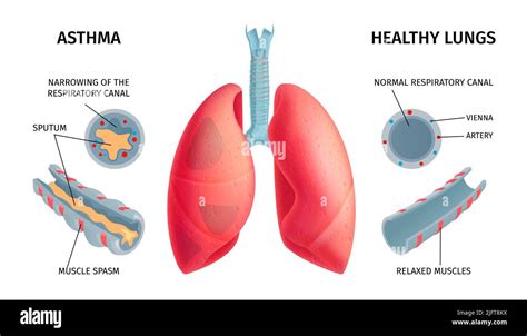 Human lung anatomy respiratory asthma disease symptoms medical ...