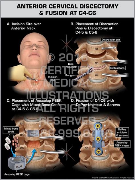 The exhibit illustrates anterior surgery of the cervical spine to remove disc herniations at C4 ...