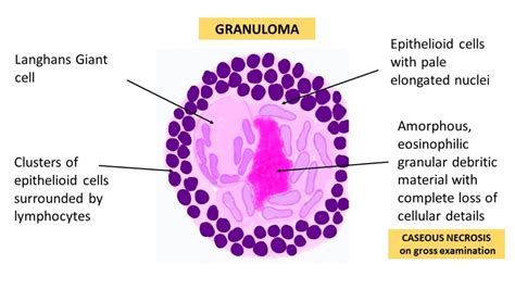 GRANULOMATOUS INFLAMMATION - Pathology Made Simple