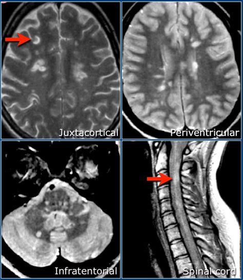 30 best The brain MRI images on Pinterest | Brain, Neurology and Radiology