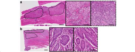 Photomicrographs of two cases with a heterogeneous PIK3CA mutation ...