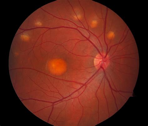 Best disease: Egg yolk appearance of macula. | Retinal photography, Fundus photography, Retina ...