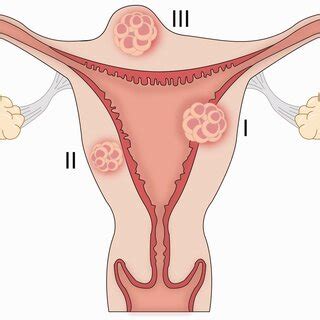 Three types of myomectomy scar pregnancy. | Download Scientific Diagram