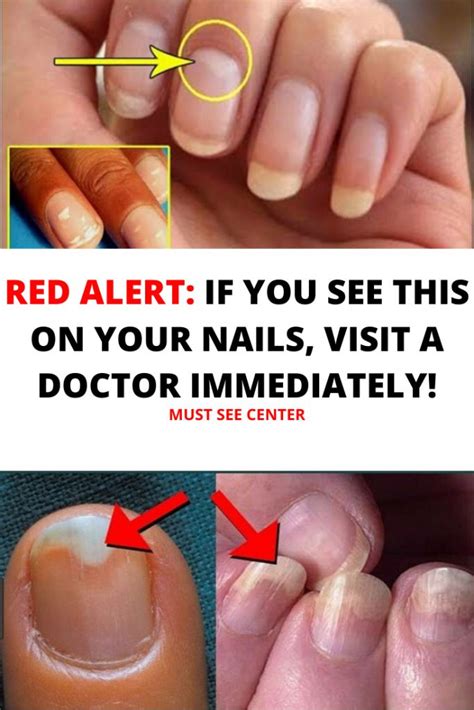 RED ALERT: IF YOU SEE THIS ON YOUR NAILS, VISIT A DOCTOR IMMEDIATELY! | You nailed it, Health ...