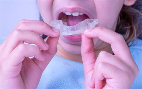 110+ Occlusal Splint Stock Photos, Pictures & Royalty-Free Images - iStock