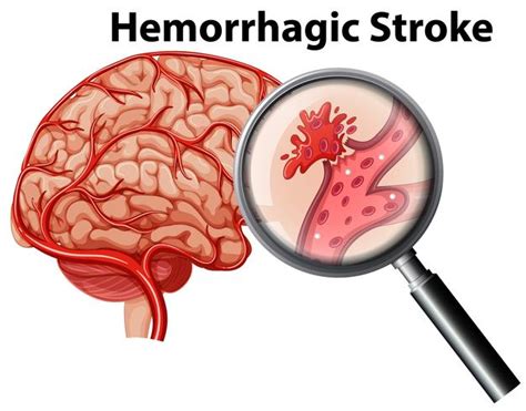 A human anatomy hemorrhagic stroke 417761 Vector Art at Vecteezy