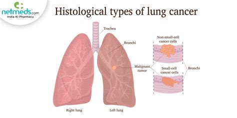 Small Cell Lung Cancer: Causes, Symptoms And Treatment