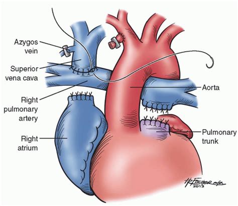 Tricuspid Atresia/Single Ventricle and the Fontan Operation | Thoracic Key