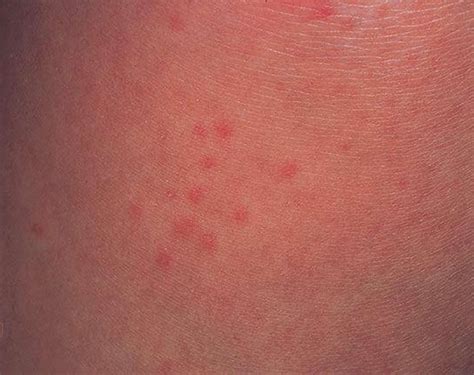 Cholinergic Urticaria - Causes, Diagnosis, Treatment and Prevention