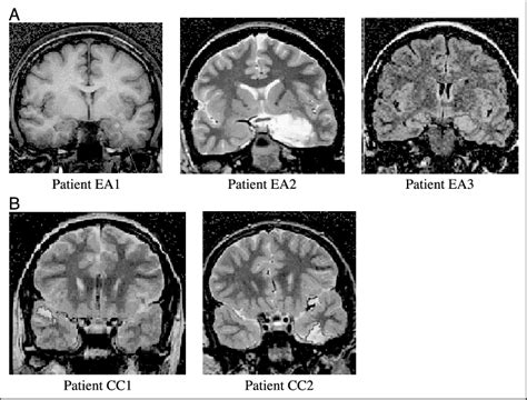 Selected MR images of patients in the early amygdala damage and ...