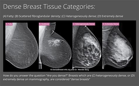 Breast Density - Carolina Breast Imaging Specialists