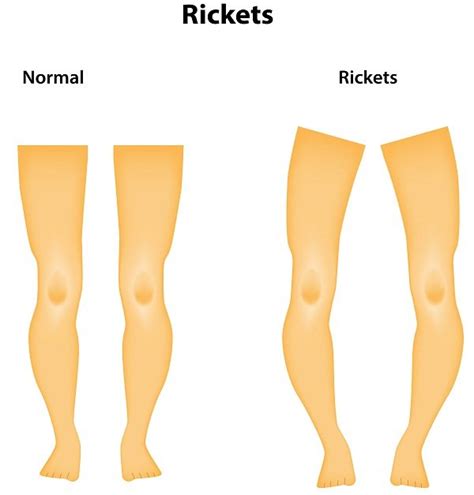 Rickets Symptoms, Causes & Prevention - DiseaseFix