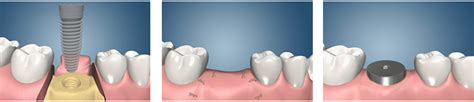 Dental Implant Procedures