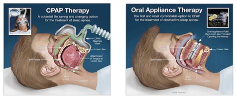 CPAP vs Oral Appliance - Sleep Apnea & Snoring Treatments in Glen Mills, PA