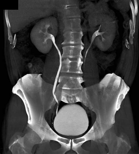 Normal CT Urogram - Kidney Case Studies - CTisus CT Scanning