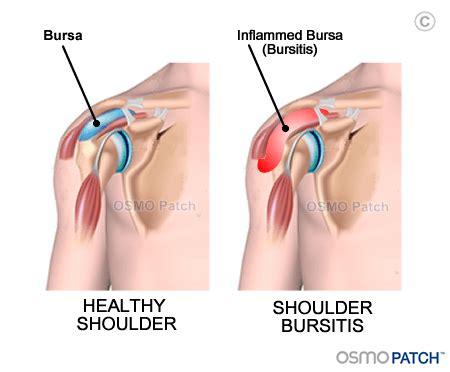 Shoulder Bursitis Information - What is Shoulder Bursitis | OSMO Patch US