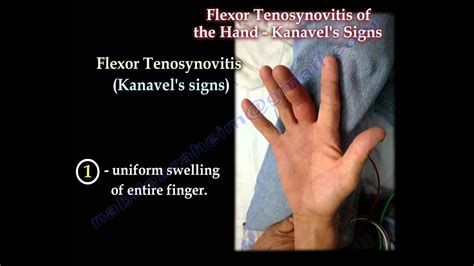 Flexor Tenosynovitis Of The Hand Kanavel's Signs - Everything You Need ...