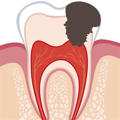 Pulpitis » Children's Dentistry