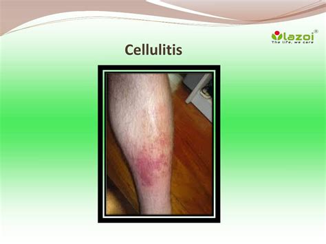 PPT - Cellulitis: Symptoms, Causes, Diagnosis, Treatment, Prevention and Complications ...