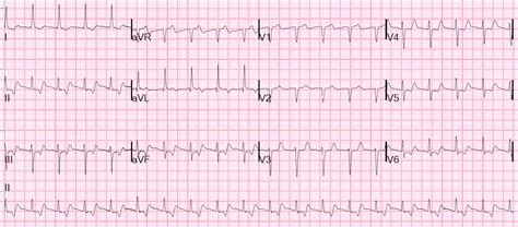 Dr. Smith's ECG Blog: You can get fooled if you don't read the ECG systematically