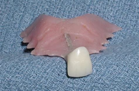 Temporary Tooth Replacement options - Christine M. Ford, DDS Periodontics, Implants, and ...