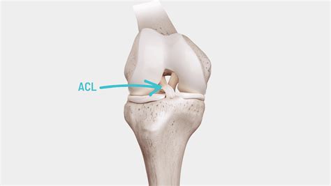 ACL Rupture Surgery or ACL Rupture With Surgery